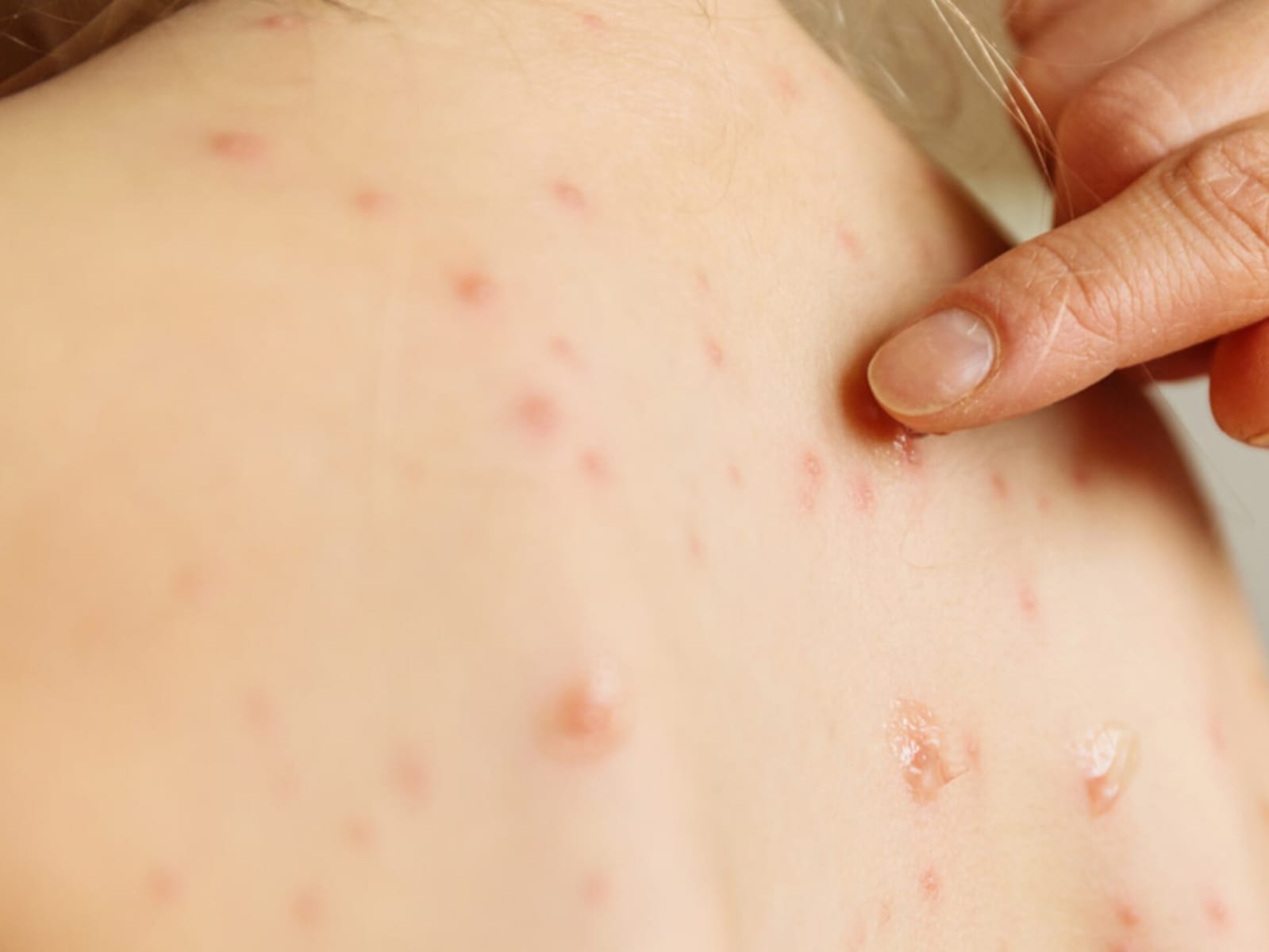 Comunicado del CECOED ante caso de sarampión en Fray Bentos